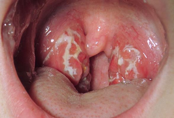 MONONUCLEOSE INFECCIOSA AGENTE: Virus Epstein Barr TRANSMISSÃO: contato com a saliva (doença do beijo) CLÍNICA: PRÓDROMOS: faringoamigdalite Febre, adinamia, malestar,