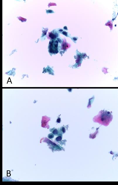 do canal anal (AIN1) (Fig.3A e B) e focalmente lesão intraepitelial pavimentosa de alto grau do canal anal (AIN2) (Fig.3A).