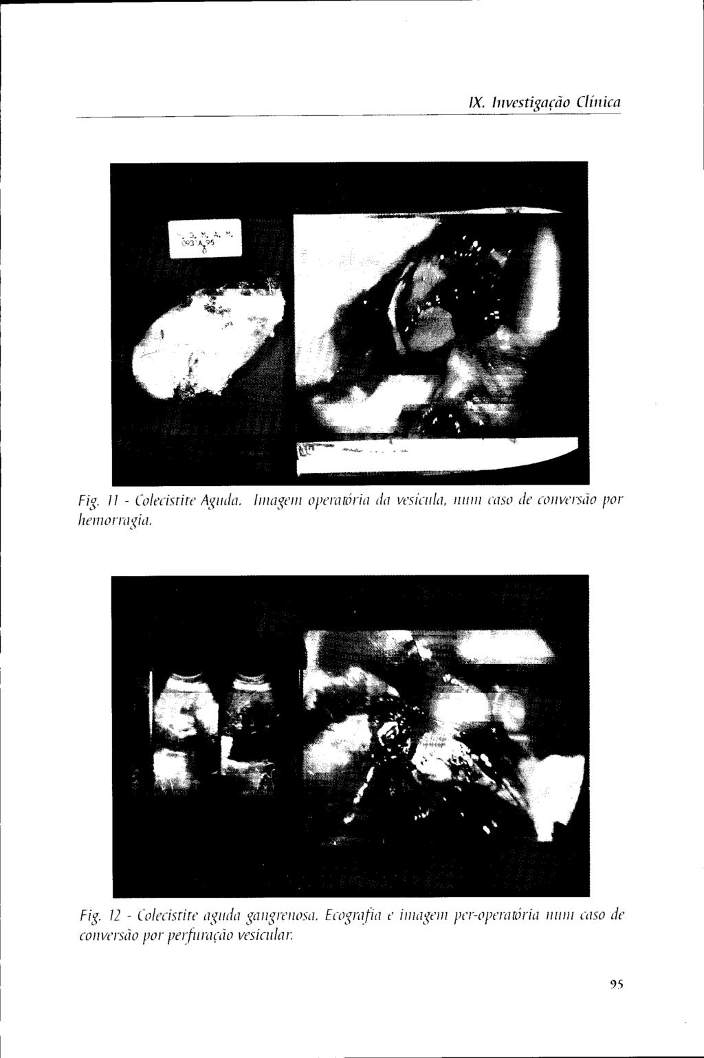 IX. Investigação Clínica Fig. il - Colecistite Aguda. Imagem operatória da vesícula, num caso de conversão por hemorragia.