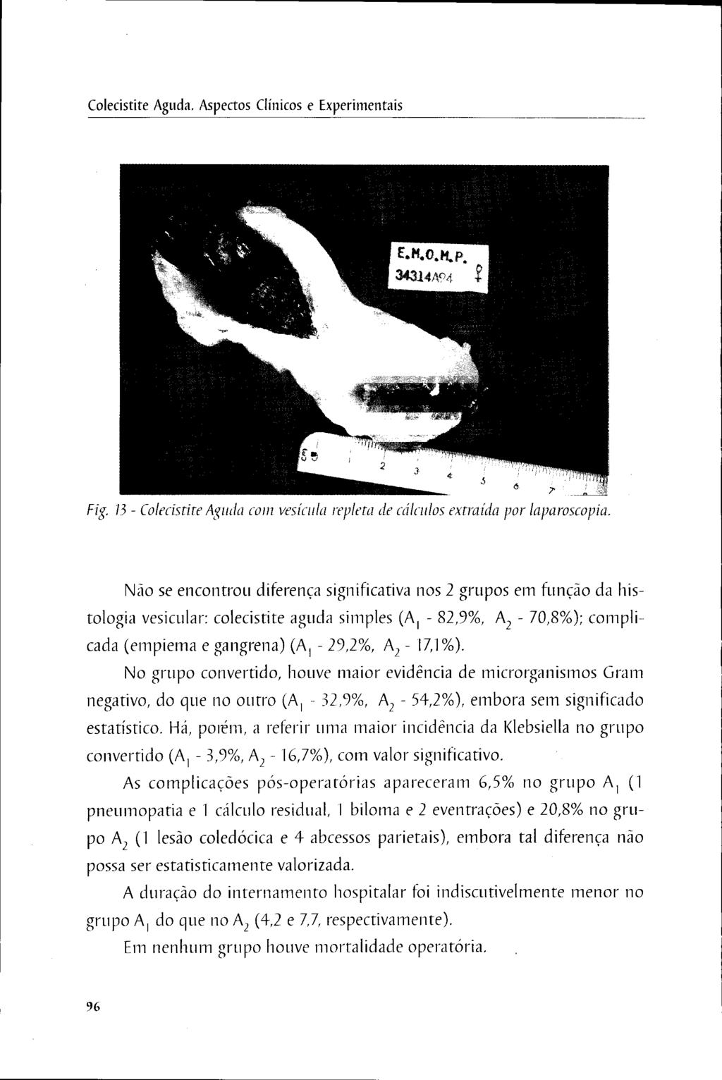 Colecistite Aguda. Aspectos Clínicos e Experimentais Fig. 15 - Colecistite Aguda com vesícula repleta de cálculos extraída por laparoscopia.