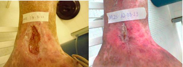 Mulher 52 anos Paciente com ferida vascular em perna esquerda que não cicatriza