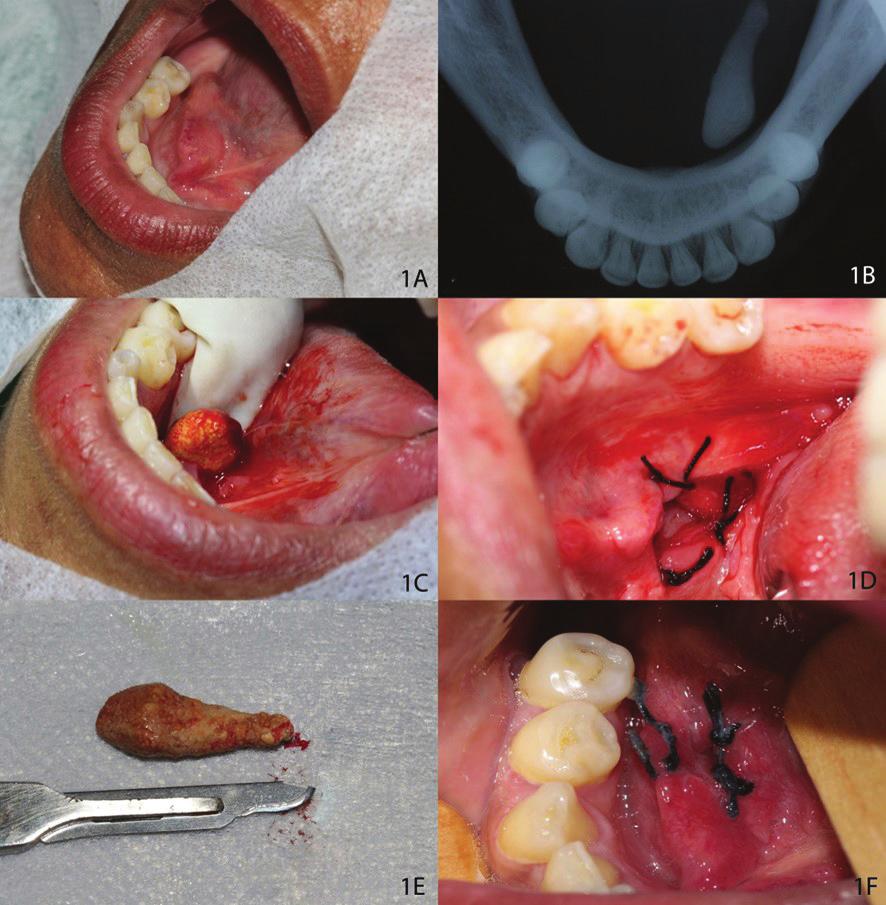 INTRODUÇÃO A sialolitíase é uma alteração não neoplásica, acarretada pela obstrução da glândula salivar ou de seu ducto excretor, pela formação de cálculos (sialólitos) e pela deposição de sais de