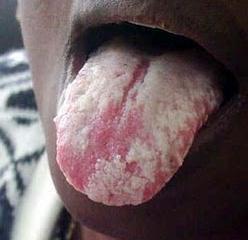 Mucosa oral e orofaringe: Coletar com swab (*) estéril o material de lesão de mucosa jugal, papilas linguais ou região tonsilar.