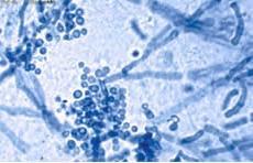 EXAME MICROSCÓPICO DE AMOSTRAS CLÍNICAS A observação de um fungo na amostra biológica tem grande valor diagnóstico (padrão ouro) pois