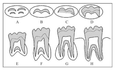 Em cada OPT procedeu-se à análise segundo os estadios de mineralização descritos por Demirjian 1,2 (Figura 1) do segundo molar mandibular esquerdo (dente 37).