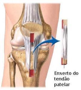 Quais técnicas poderão ser