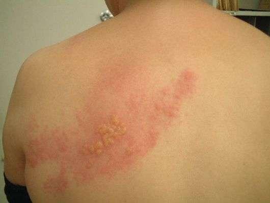 CATAPORA Herpes Zoster O vírus tem a habilidade de ficar latente no corpo Migra ate os gânglios nervosos que ficam perto da coluna Após um longo período (baixa imunidade)