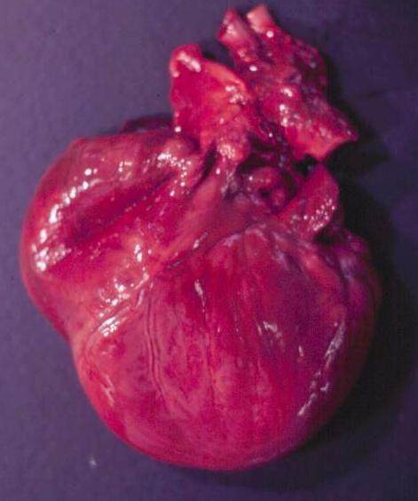 hipertireoidismo, hipertensão (IRC) HVB - cardiomiop atia hipertrófica, malformações