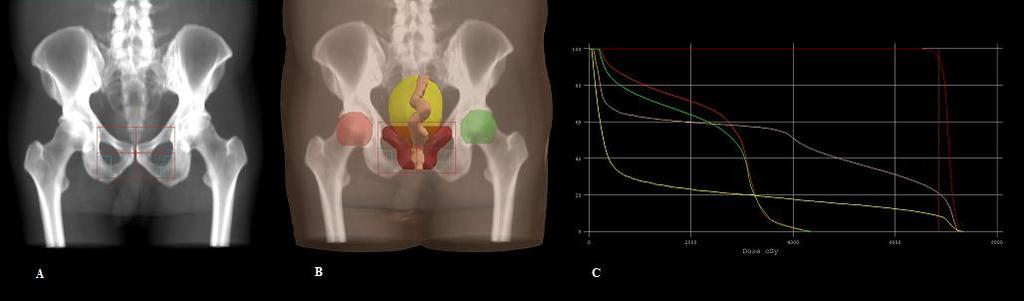 Monografia 16 Figura 1. Imagens de um caso de próstata (A) DRR; (B) BEV e (C) DVH.