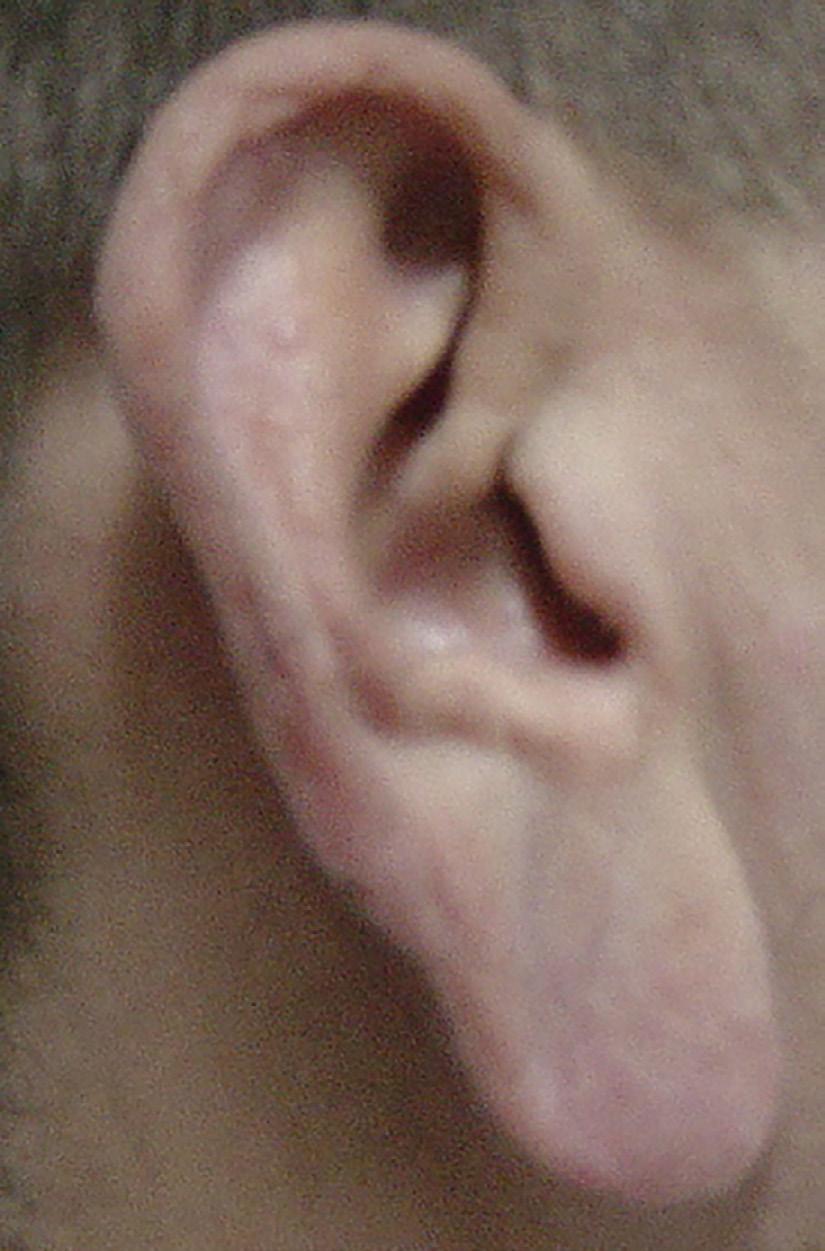 Faial MMG et al. O lóbulo é classificado de acordo com sua aderência na face na borda mandibular.