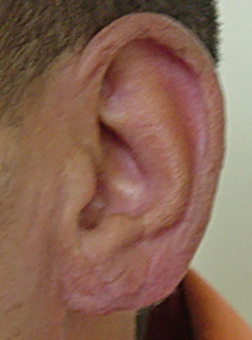 para manter o pedículo da borda livre do lóbulo da orelha com um tamanho razoável. Na situação deste paciente o ângulo estabelecido pelos pontos X, Y e Z foi de 25 graus.