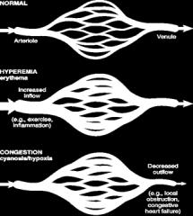 3. Hiperemia e Congestão Aumento localizado de sangue Hiperemia Processo ativo Fluxo sanguíneo aumentado Ex.