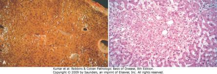 Alteração gordurosa de hepatócitos periportais Congestão hepática crônica Regiões centrolobular vermelho-marrom (morte celular) Zonas