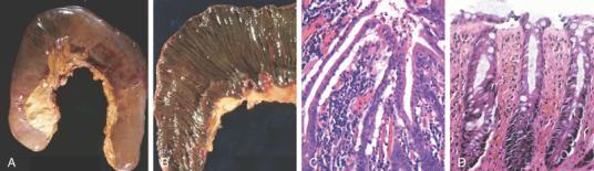 Púrpuras- hemorragias levemente maiores (trauma, vasculite, aumento fragilidade vascular - ex.