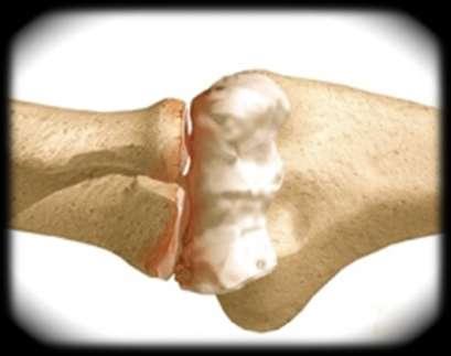 ARTROSE DO COTOVELO A articulação do cotovelo é menos frequentemente atingida pela artrose, a não ser como