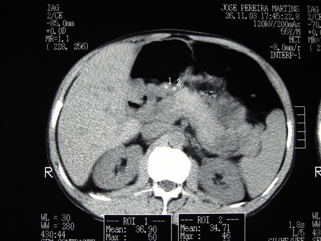39 FIGURA 01- Corte tomográfico abdominal após ingestão de 500mL