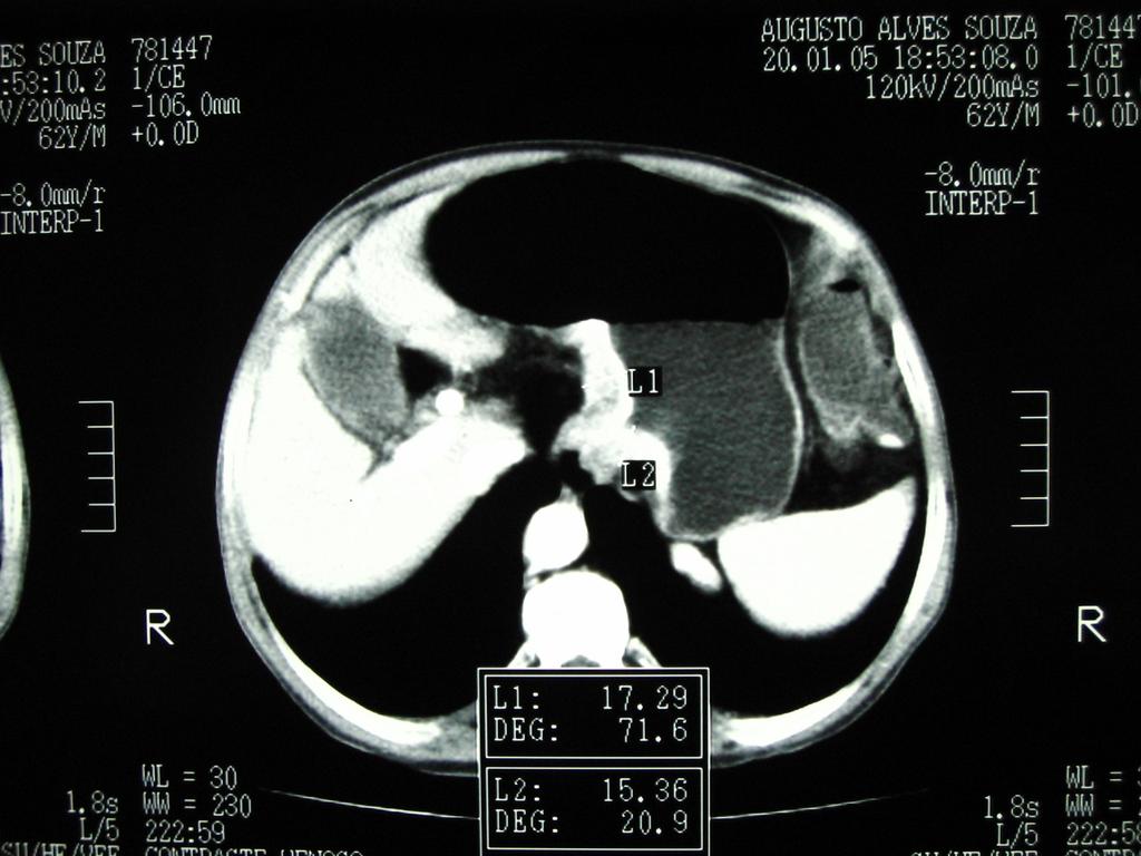 FIGURA 02- Corte tomográfico abdominal após ingestão de 500mL de