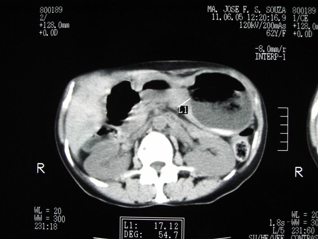 41 FIGURA 04- Mensuração tomográfica do ponto de maior espessura do tumor gástrico em milímetros.