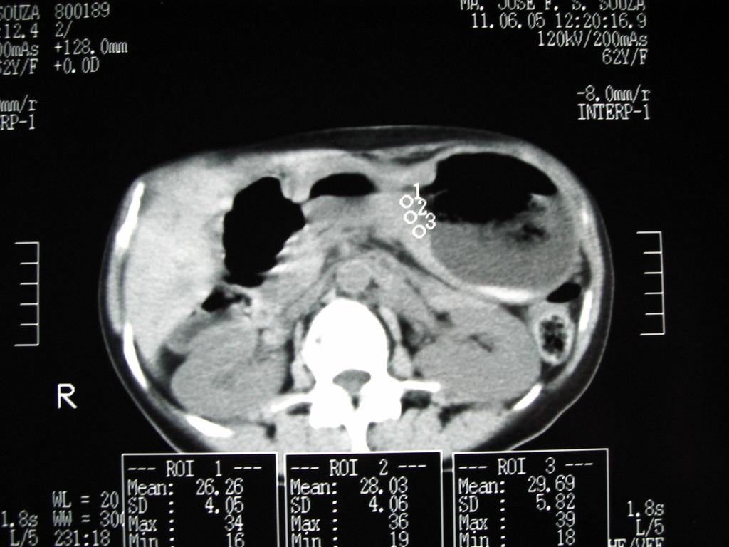 42 FIGURA 05- Mensuração tomográfica da atenuação (em unidades de Houndsfield) em três diferentes