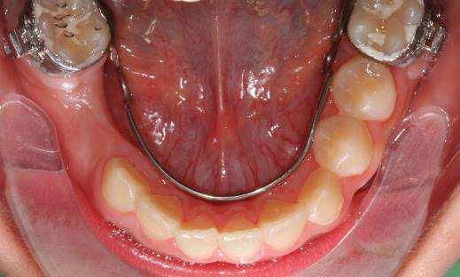 O arco lingual geralmente é removido depois que a erupção dos dentes sucessores esteja completa e o posicionamento adequado destes dentes for alcançado 32. Fig.2- Arco lingual de Nance.