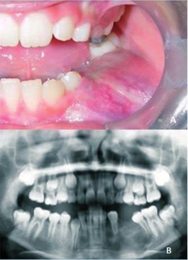 RELATO DE CASO Paciente de oito anos de idade, gênero feminino, leucoderma foi encaminhada ao Serviço de Cirurgia e Traumatologia Buco-maxilo-facial da Universidade Federal do Paraná, com aumento de