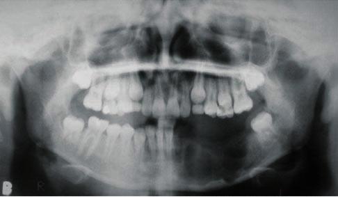 corso, et al. 76 pré-molares e pela agenesia do 33, para futura reabilitação protética. Durante o acompanhamento clínico e radiográfico, verificou-se a recidiva da lesão, 15 meses após a intervenção.