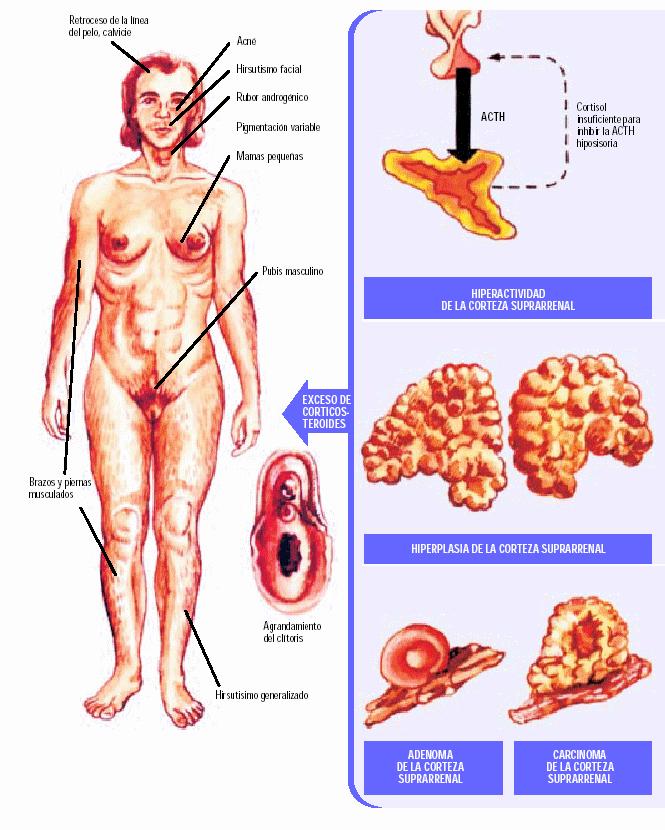 Hiperplasia Congênita da Supra-Renal Ocorre em mulheres que apresentam uma quantidade de hormônios masculinizantes muito acima do nível normal por causa de uma