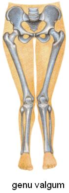Joelho Valgo Joelho valgo é a projeção dos joelhos para dentro da linha média do corpo. Os pinos são inseridos na epífise primeiramente.