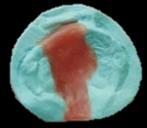 Figura 14 - A: modelo de gesso de maxila de recém-nascidos com FLPUC; B: