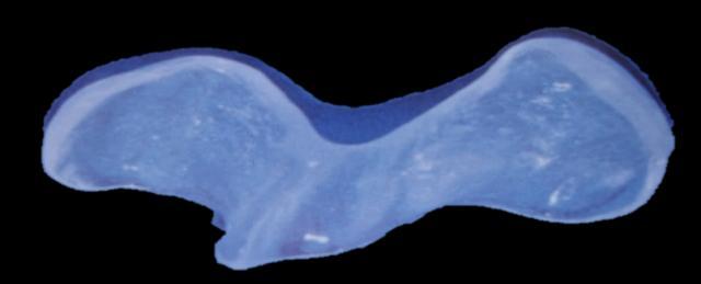 Lapa (1970) (Figura 16). Delimitação em todo o fundo de saco, com alívio na região da fissura.