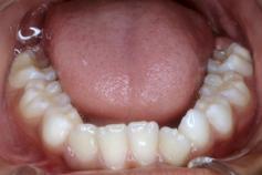 incisivos superiores para palatino ou normal, ausência de mordida cruzada e aberta e morfologia da arcada dentária superior satisfatória,