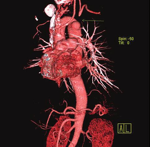 Kommerell, em 1936, descreveu uma artéria subclávia direita aberrante com origem da aorta torácica descendente, associada a persistência de remanescente da aorta dorsal direita 3.