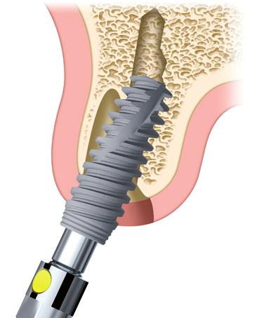 O colo em forma de cone invertido proporciona um volume ósseo adicional.