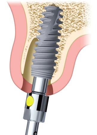 perfuração apical permitem que os clínicos experientes ajustem a posição do implante para uma orientação