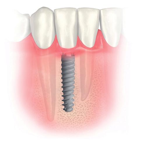 GARANTIA Em todos os implantes da Nobel Biocare, incluindo componentes protéticos pré-fabricados. 33059 GMT Nobel Biocare Services AG, 2012. Todos os direitos reservados.