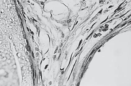FIGURA 3 Poros do polímero () preenchidos por tecido conjuntivo ( ), com presença de células gigantes ( ). H.E. 400 x.