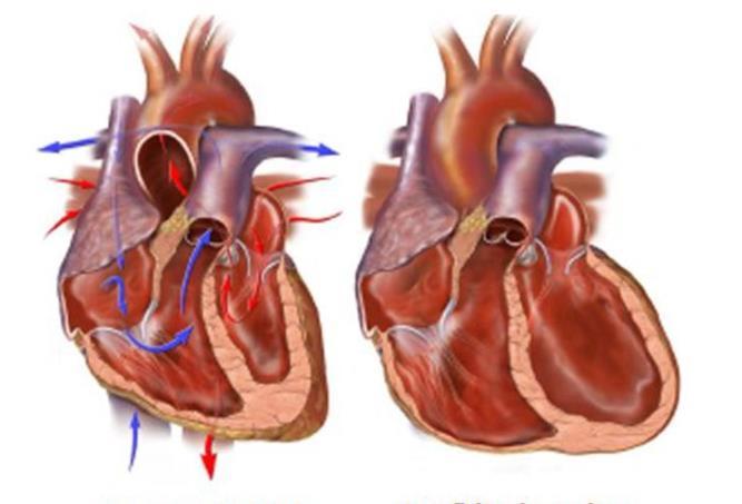 Como ocorre a insuficiência cardíaca Quando