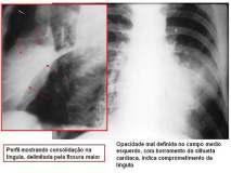 Sinal da silhueta na língula Sinal da silhueta no LIE Sinais de lesão pulmonar Dois sinais