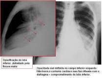 periferia do pulmão, em contato com a parede torácica, mediastino ou diafragma.