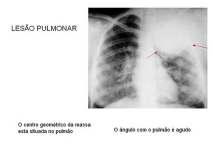 Lesão Pulmonar Sinais de lesão extra-pulmonar Sinal do ângulo obtuso: se