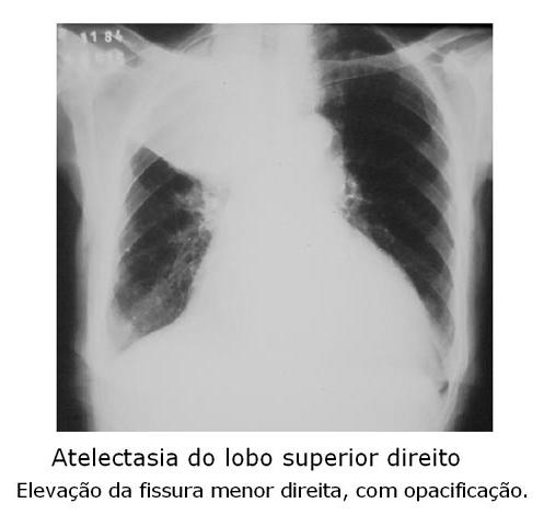 Atelectasia Redução do volume pulmonar Sinais diretos Deslocamento da fissura Opacidade Aproximação dos vasos Sinais indiretos Hiperinsuflação compensatória Desvio do mediastino