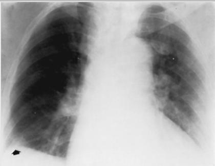 Derrame pleural subpulmonar O pico do contorno pseudo-diafragmático (seta)