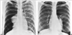 Pneumotórax Colapso completo do pulmão em dois diferentes pacientes Notar a