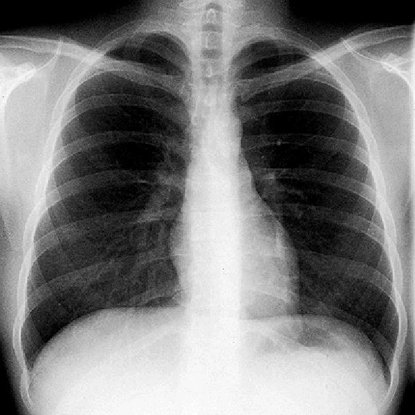 Radiograma em PA Forma mais comum de radiografia de tórax Obtida com a incidência posterior dos raios X Vantagem das radiografias em PA Evita a magnificação excessiva do coração Possibilita