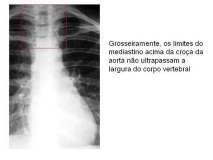 arco médio da pulmonar - Silhueta da croça da aorta - Silhueta da A.