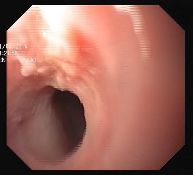 alterações Biopsias: DII, antro e corpo sem alterações