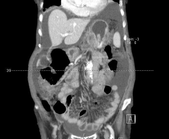 no corpo gástrico Ascite Iniciou Suplementação com ferro