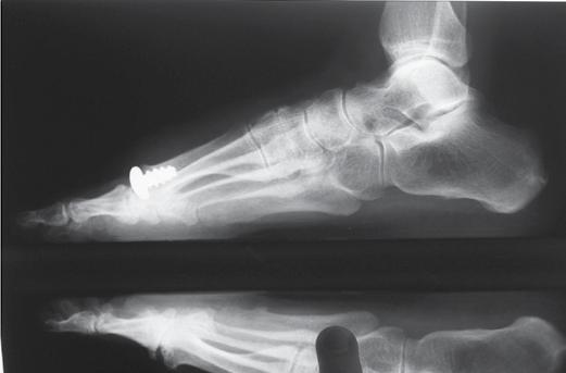 74 Figura 1. Radiografia perfil do pé com carga do paciente seis com 24 meses de pós-operatório. Figura 2. Radiografia frente do pé com carga do paciente seis com 24 meses de pós-operatório.