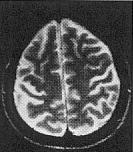 A atrofia do córtex calcarino é mais grave na região mais anterior. A atrofia dos hemisférios cerebelares também pode ser vista. Feldman, 1997 E D.