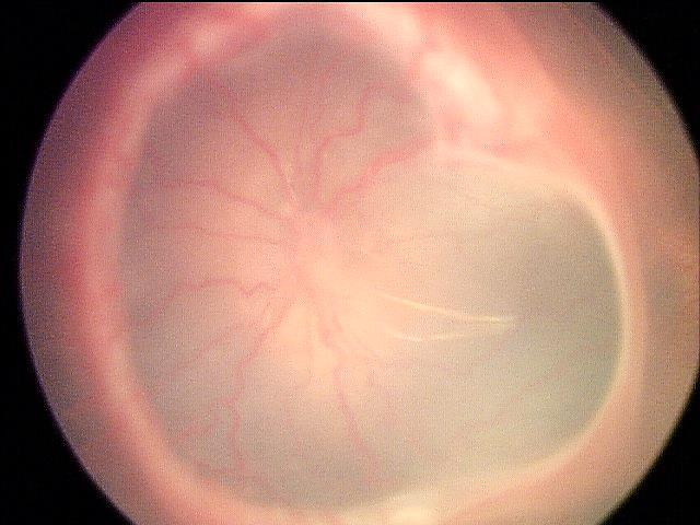 Figura 7. Estágio 4B - Descolamento parcial com acometimento macular.